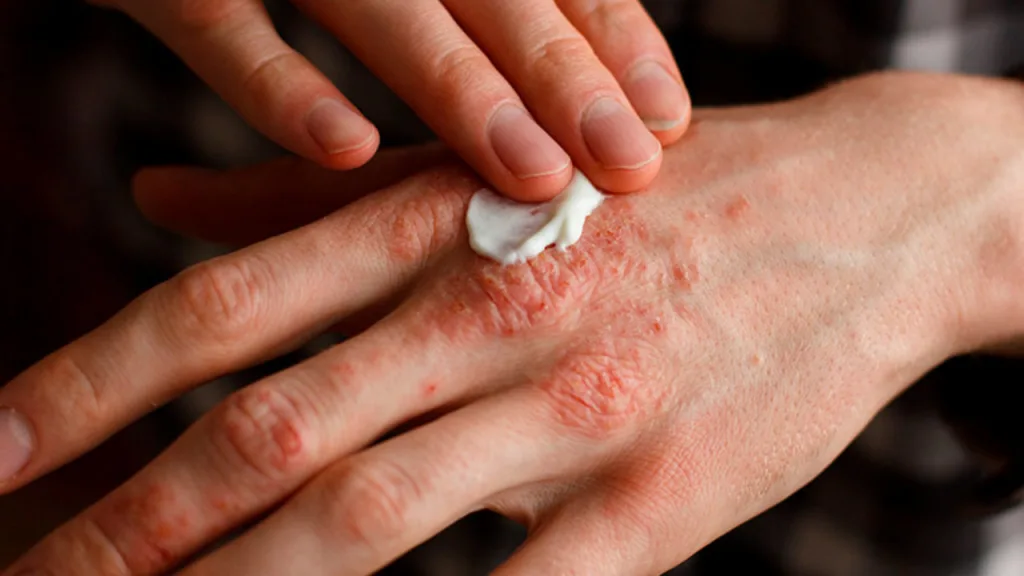 eczema de manos